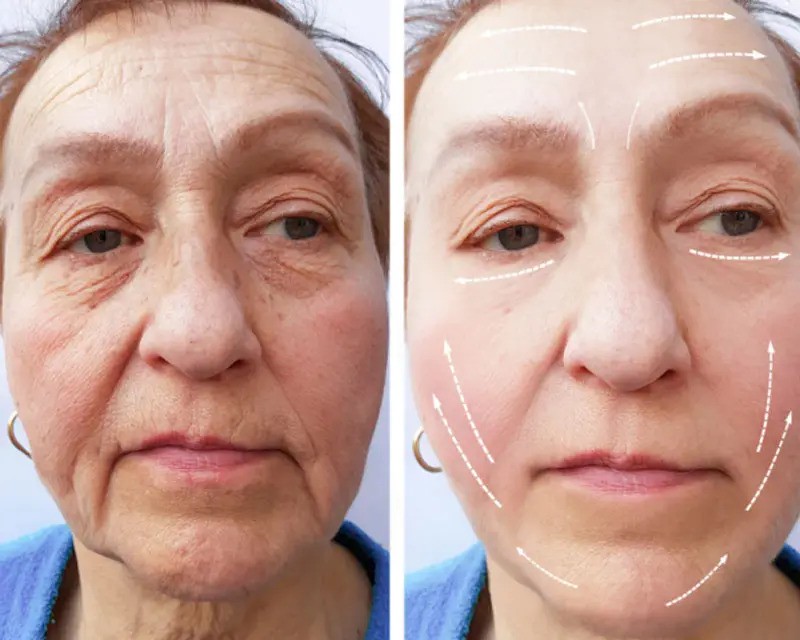 لیفت صورت با نخ در اصفهان