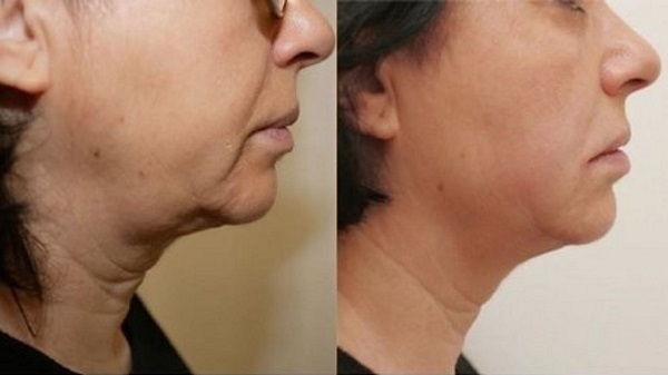 هایفوتراپی در اصفهان