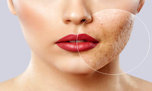 ۴ کرم ضدجوش و آکنه موثر برای پوست صورت + قیمت