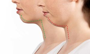 جراحی فک مناسب چه کسانی است؟